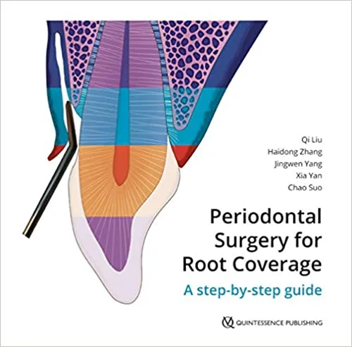 *Periodontal Surgery for Root Coverage:A step-by-step guide