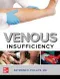 Venous Insufficiency (IE)