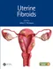 Uterine Fibroids