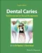 Dental Caries: The Disease and Its Clinical Management