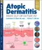 Atopic Dermatitis: Inside Out or Outside In ?