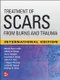 Treatment of Scars from Burns and Trauma (IE)