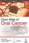 Color Atlas of Oral Cancer