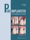 Peri-Implantitis: From Diagnosis to Treatment