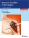 *Reverse Shoulder Arthroplasty: A Practical Approach