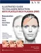 Illustrated Guide to Collagen Induction with Platelet-Rich Plasma (PRP)