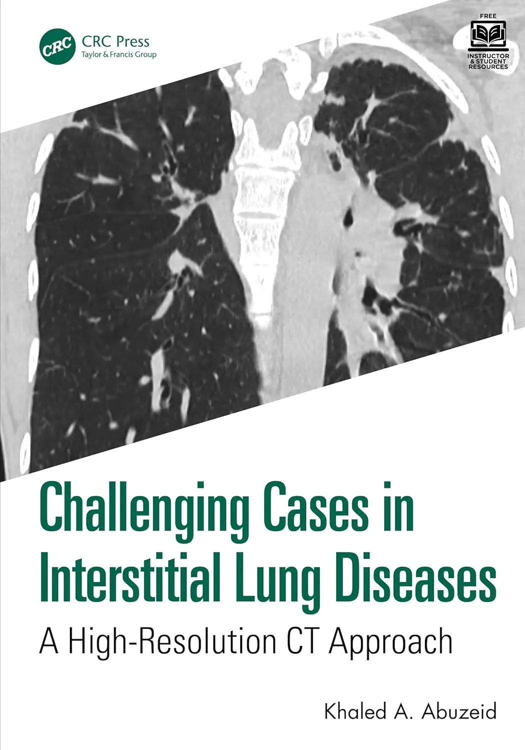 Challenging Cases in Interstitial Lung Diseases: A High-Resolution CT ...