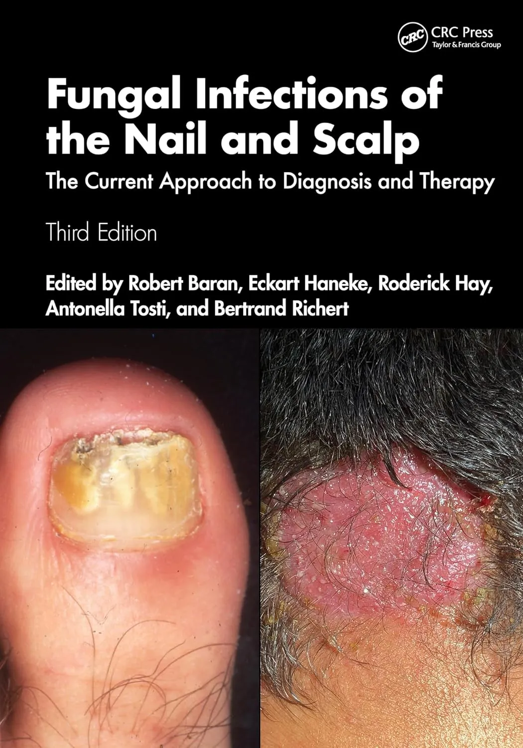 Fungal Infections of the Nail and Scalp: The Current Approach to ...
