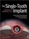 *The Single-Tooth Implant: A Minimally Invasive Approach for Anterior and Posterior Extraction Socket