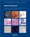 *WHO Classification of Breast Tumours