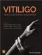 Vitiligo: Medical and Surgical Management