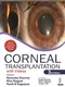 Corneal Transplantation (with Videos)