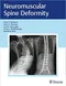 Neuromuscular Spine Deformity